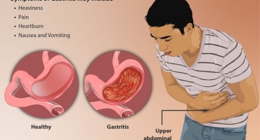 NHỮNG NGUYÊN NHÂN GÂY RA VIÊM DẠ DÀY MÀ BẠN KHÔNG THỂ NGỜ